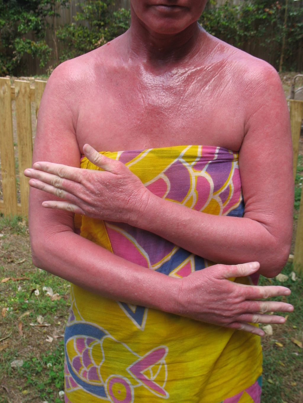 Sindrom rdeče kože: »gorenje« pri živem telesu
