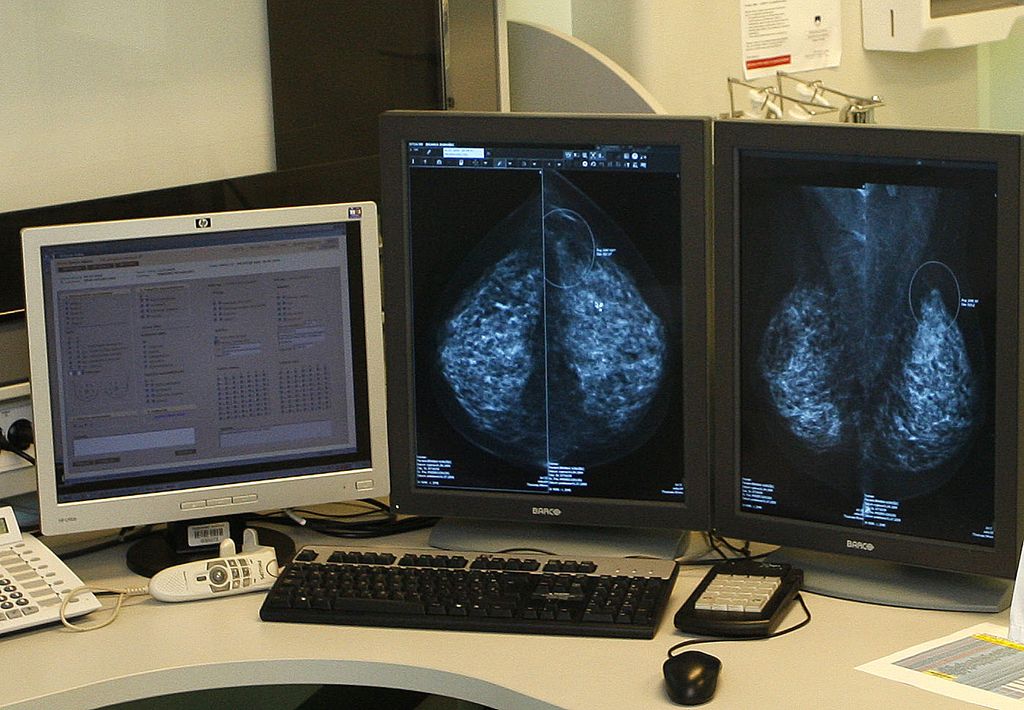 Ptujski mamograf za DORO